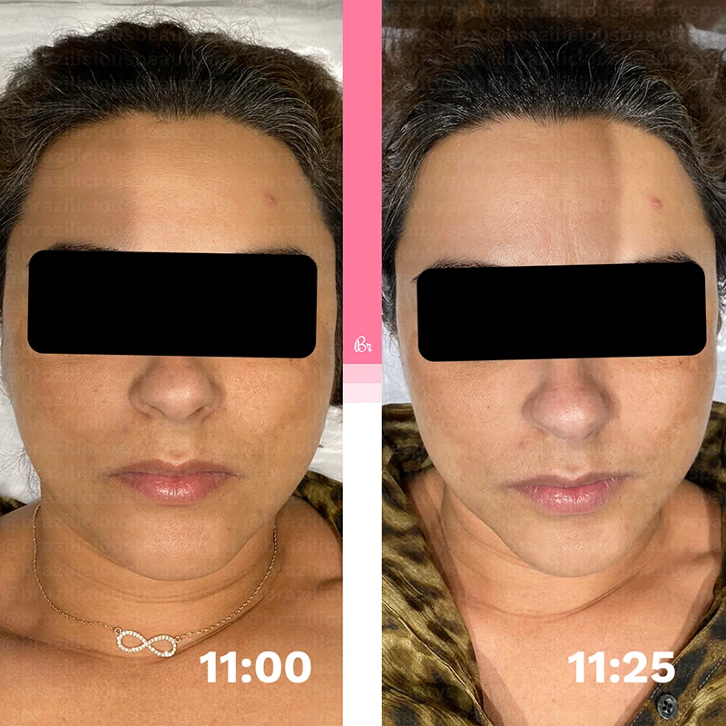 Before and after - Face